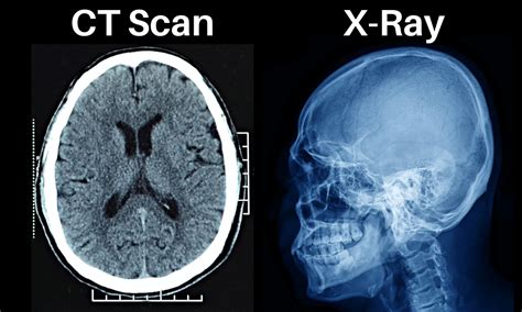 Perbedaan CT Scan dan X-Ray