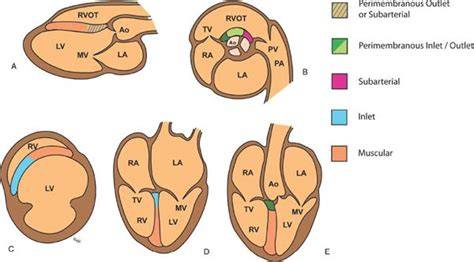 Perimembranous VSD Location