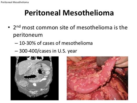 Peritoneal Cancer: How It’s Connected to Asbestos