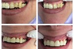 Permanent Bridge for Front Teeth