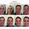 Photodynamic Therapy Face