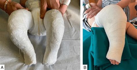 Plaster of Paris Cast