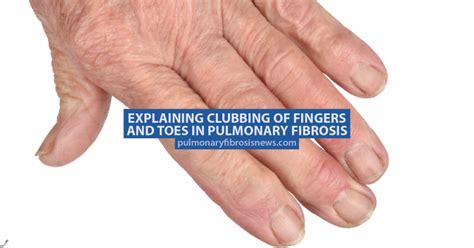 Finger Clubbing