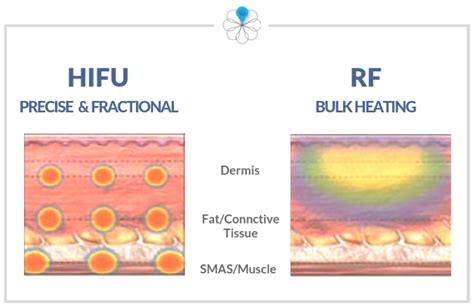 Perbedaan RF dan HIFU