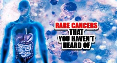 Rare Asbestos-Linked Cancers: What You Should Watch For