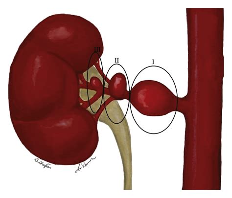 Renal Artery Aneurysm