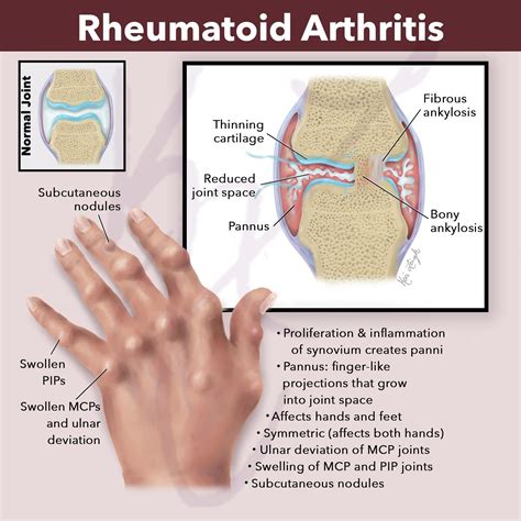 Rheumatoid Arthritis affecting hand joints