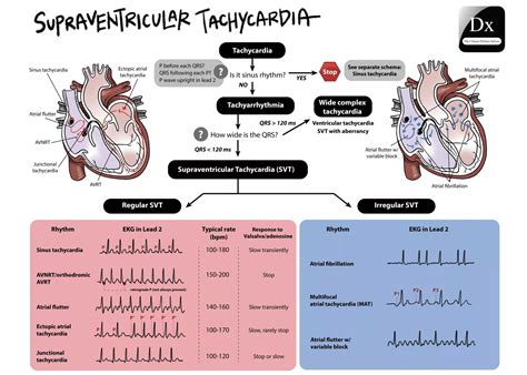 vs Tachycardia