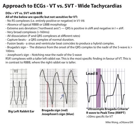 vs VT ECG