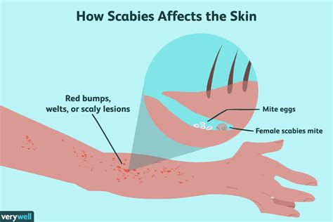 Scabies
