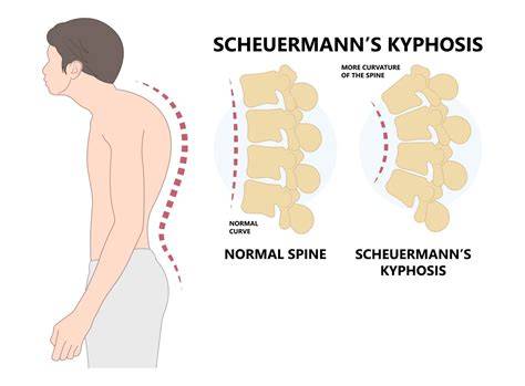 Kifosis Scheuermann