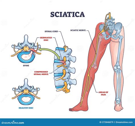 Ilustrasi nyeri sciatica akibat HNP