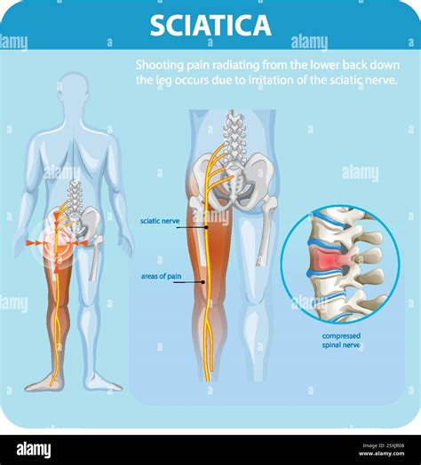 Sciatica Pain