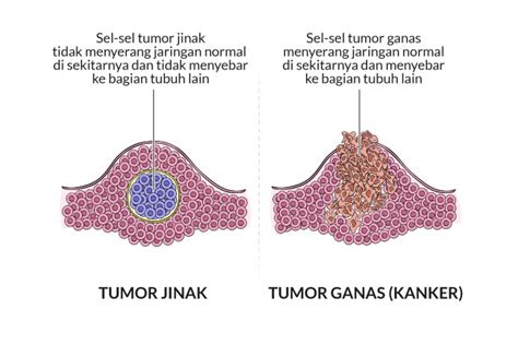 Sel Kanker Ganas