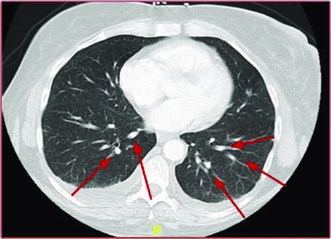 Septic Pulmonary