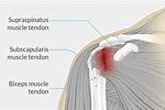 Shoulder Tendonitis Symptoms