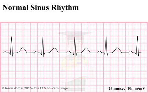 Sinus Rhythm