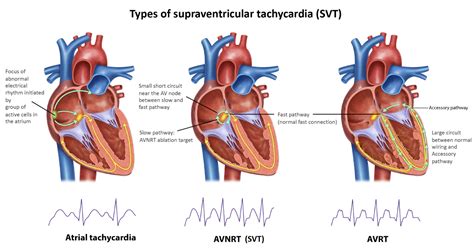 Sumber Aritmia SVT dan VT
