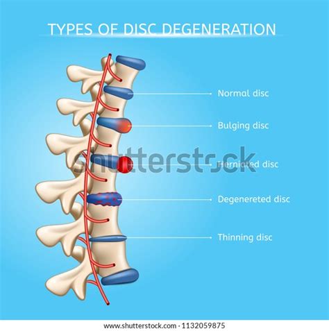 Ilustrasi proses degenerasi bantalan tulang belakang