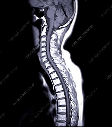 Pemeriksaan MRI Tulang Belakang