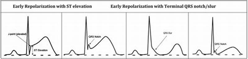 St Elevation Probable Normal Early Repol Pattern