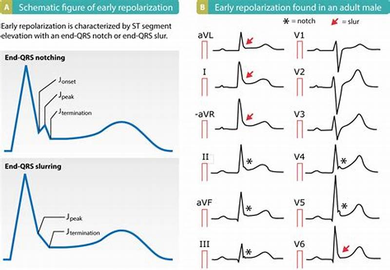 St Elevation Probable Normal Early Repolarization Pattern