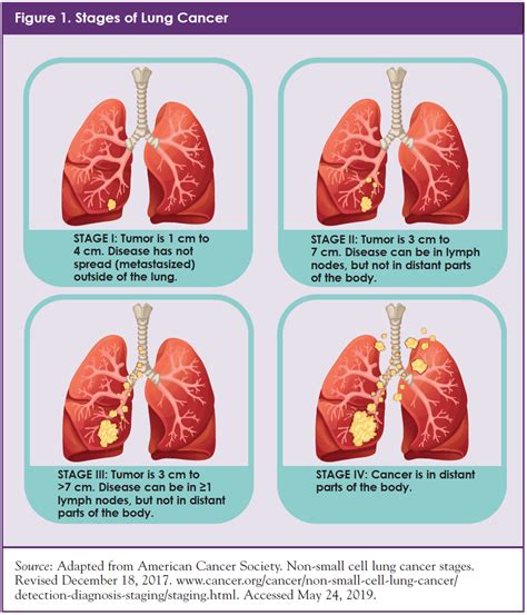 Non Small Cell Lung Cancer