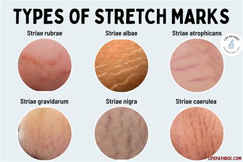Stretch Marks
