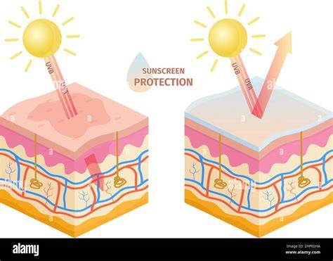 Sunburn UV Rays