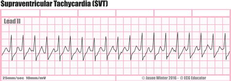 Tachycardia Heart Rhythm