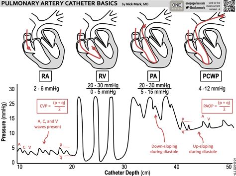 Swan-Ganz Catheter