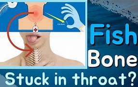 Symptoms of Fish Bone Stuck in Throat