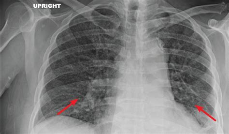 TB Milier X-ray pattern
