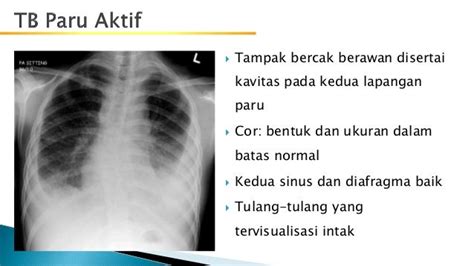 TB Paru Aktif