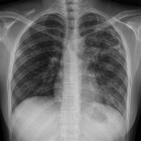 TB Paru X-ray