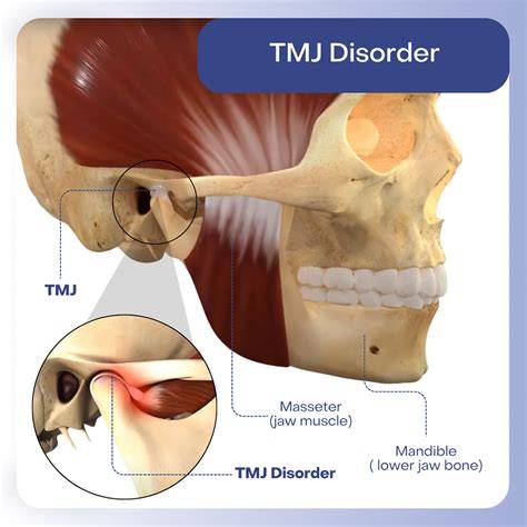Gangguan TMJ