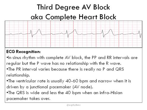 Third degree heart block