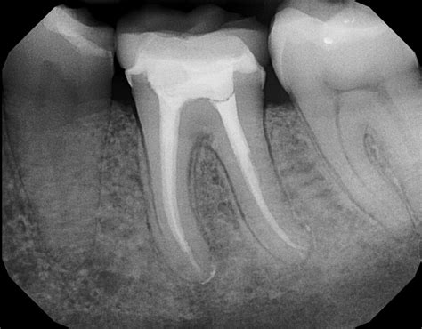 Tooth After Root