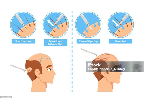 Transplantasi Rambut