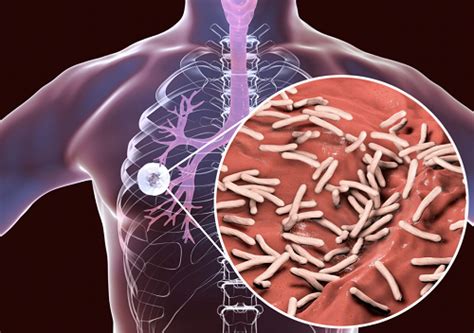 Tuberkulosis