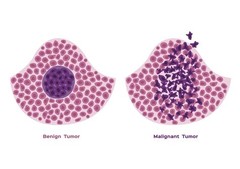 Tumor