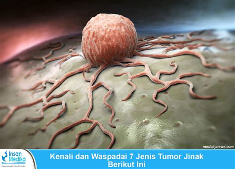 Tumor Jinak