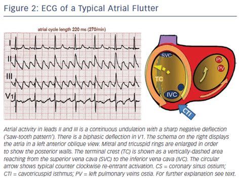 Typical Atrial