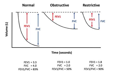 Understanding FEV1 and FVC in Spirometry