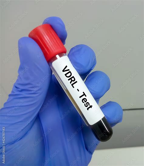 VDRL test tube