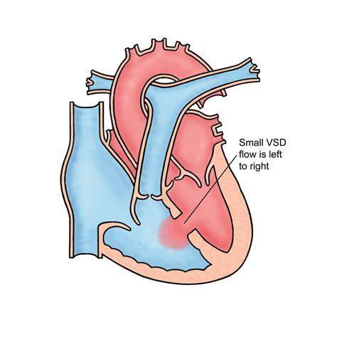 VSD Heart Defect Explained
