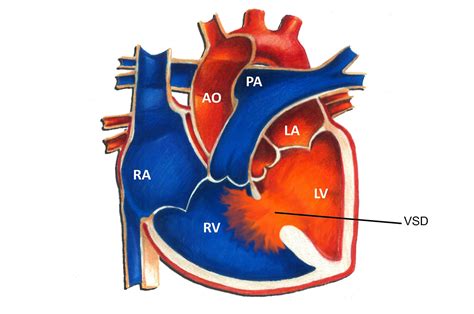 VSD heart defect diagram