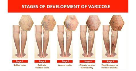 Varises pada kaki