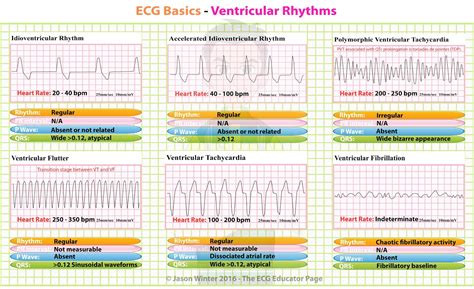 Rhythms EKG