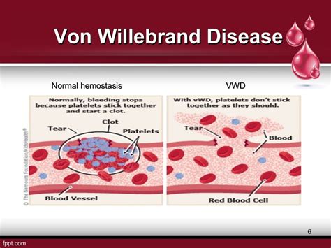 Von Willebrand's disease